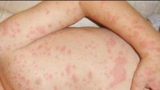 انتشار وباء البوحمرون بفيض البطمة يقلق السكان