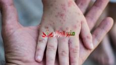 عدم تسجيل أي حالة لجدري القردة بالجزائر.. إجتماع لمتابعة تطور الوباء