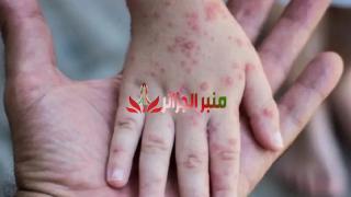 عدم تسجيل أي حالة لجدري القردة بالجزائر.. إجتماع لمتابعة تطور الوباء